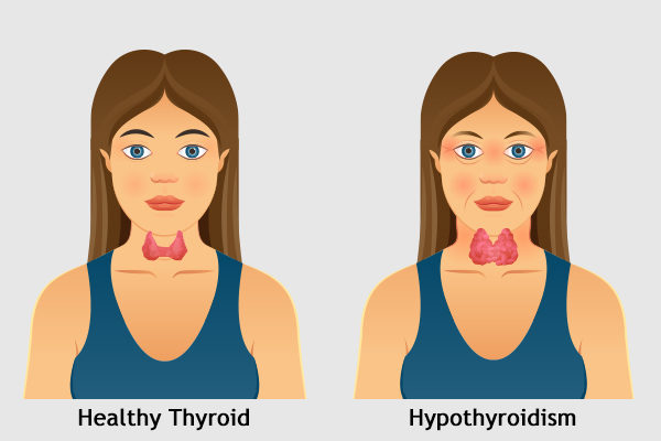 Hypothyroid คือ